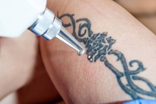 Eliminar tatuajes